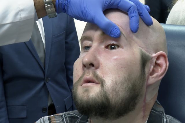 Aaron James po transplantaci oka | foto: Profimedia